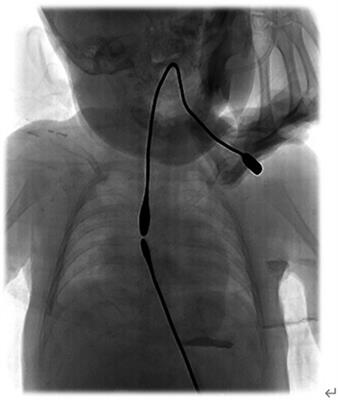 Experience in the treatment of long-gap esophageal atresia by intraluminal esophageal stretching elongation